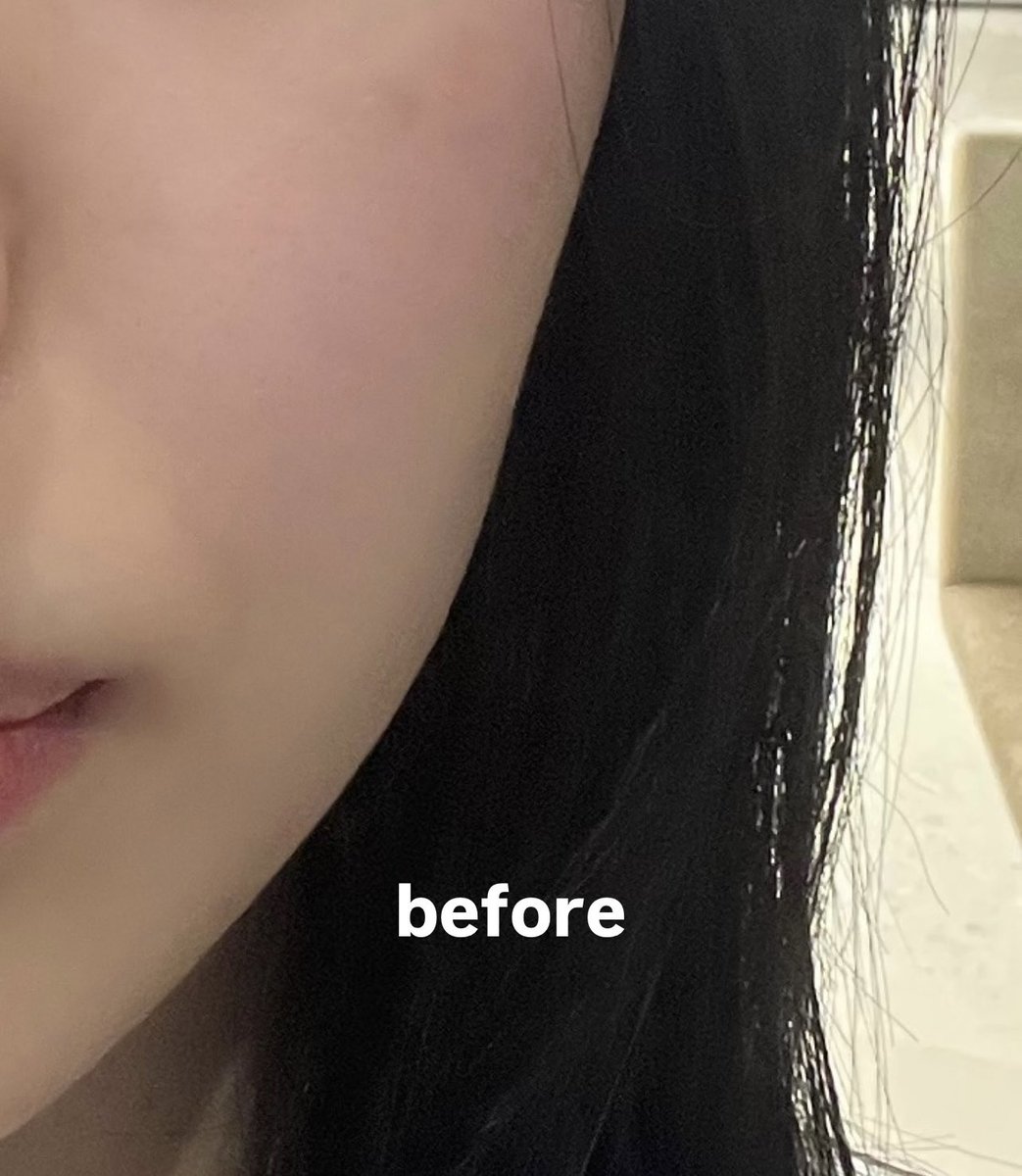 wupmputjap's tweet photo. テイアクリニック@theiaclinic_jp でオンダリフト30kj受けてきたよ❣️頬とほうれい線メインに当ててもらって、全体的に引き締まってほうれい線もちょっと薄くなった気がする🥹
Ai肌診断をしてくれて自分に何の施術が必要か何のサプリが必要か教えてくれて最新な経験させてもらった💫次は毛穴管理したい https://t.co/AwlLzviZhh