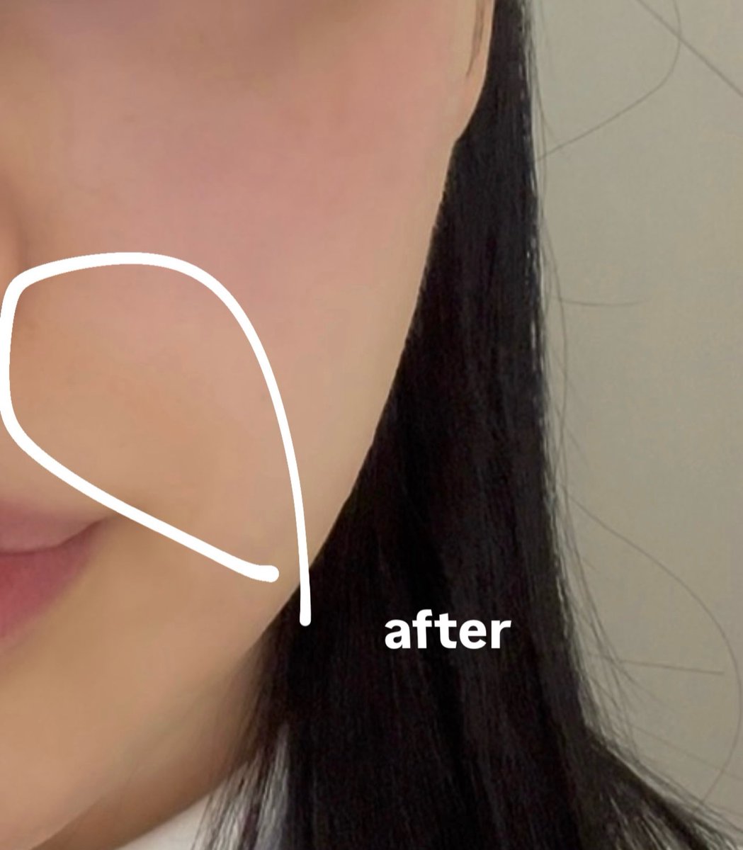 wupmputjap's tweet photo. テイアクリニック@theiaclinic_jp でオンダリフト30kj受けてきたよ❣️頬とほうれい線メインに当ててもらって、全体的に引き締まってほうれい線もちょっと薄くなった気がする🥹
Ai肌診断をしてくれて自分に何の施術が必要か何のサプリが必要か教えてくれて最新な経験させてもらった💫次は毛穴管理したい https://t.co/AwlLzviZhh