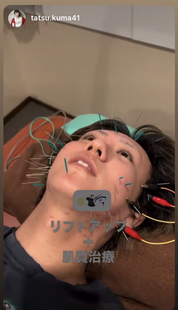 yvngrareboy's tweet photo. はじめての針治療🪡⚡️

身体の細胞が隅々活性化されていくのがわかる
点穴に刺すから結構歴史長くスピリチュアル要素あるみたい、おもろいソソるZE。。

顔の筋肉ほぐしつつ元の位置にしたり
全身だと肩こりや腰痛など他にも効果があるらしい😮

リュウの紹介❗️でコスパよくやってくれるみたいなので興味ある人連絡ください👽

#鍼灸 #整体 #鍼灸師 #針治療 #美容 #新宿 #飯田橋 #Lanitokyo