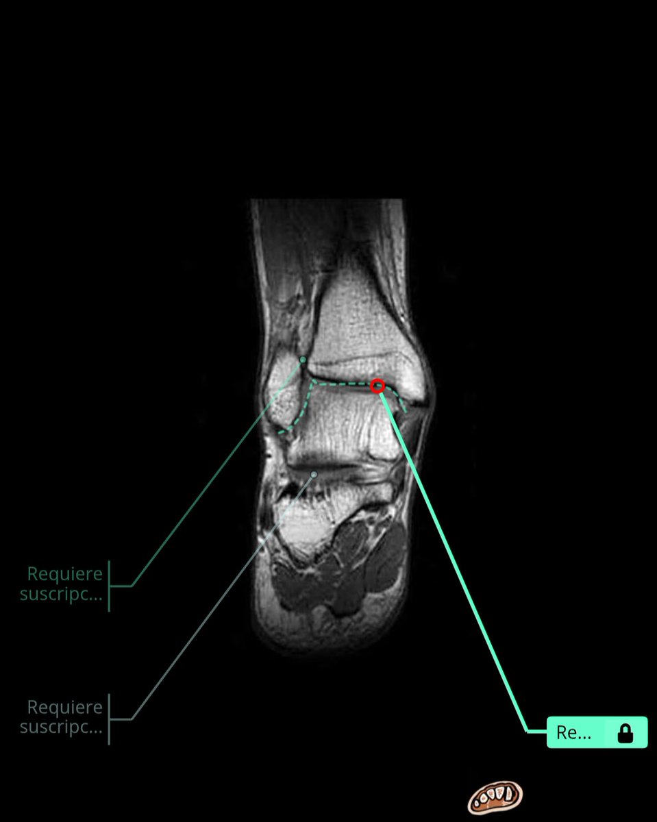 Torlsteinacst's tweet photo. Paciente con inestabilidad lateral de tobillo, el cual se le realiza artroscopia para revisión de tobillo y valoracion de probable pinzamiento anterior 

#med #medicine #tyo #orthopedicsurgery #aorenferencesurgery #traumatology #pieytobillo #footandankle #arthroscopy https://t.co/O5yTU1CVWA