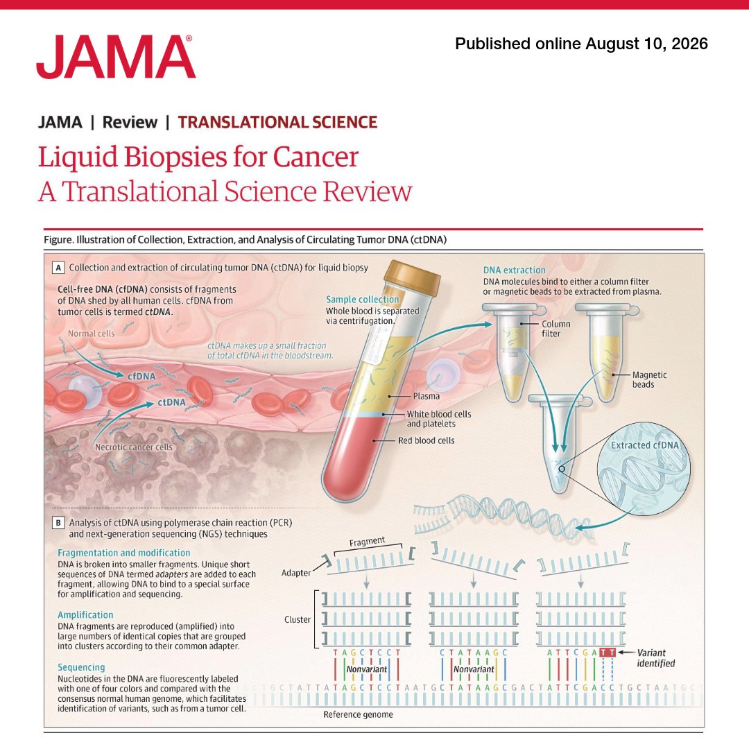 JAMA_current's tweet photo. 📝 JAMA Review: #LiquidBiopsy using circulating tumor DNA can help guide care in #Cancer by identifying gene variants associated with treatment selection, monitoring treatment response, and detecting minimal residual disease after therapy. 

https://t.co/cTPllo9bsm https://t.co/5u4SUPwpVq