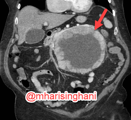 mharisinghani's tweet photo. Pancreatic acinar tumor https://t.co/MfiuTxMOfe