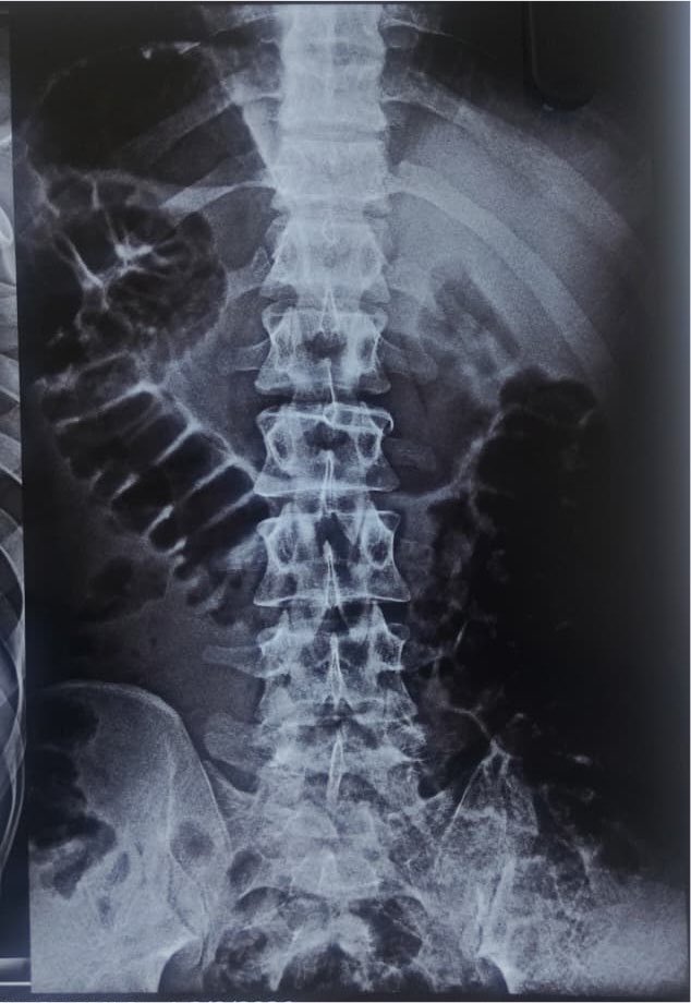 Lap_surgeon's tweet photo. Find the usual thing in this X ray!
#MedTwitter https://t.co/am6b7XfnRe