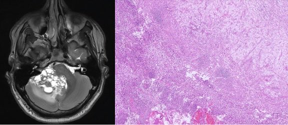 neuropathology's tweet photo. ⭐️AANP Case of the Month⭐️
Credit: Drs. @PeterKobalka &amp; Krishna Bharani @OhioStatePath
30M w/insidious ataxia and HAs. MRI (shown) with a large, enhancing cerebellar mass. Histology shown. DDX? Which immunostains would help resolve the DDX? https://t.co/CGyr1aZLks