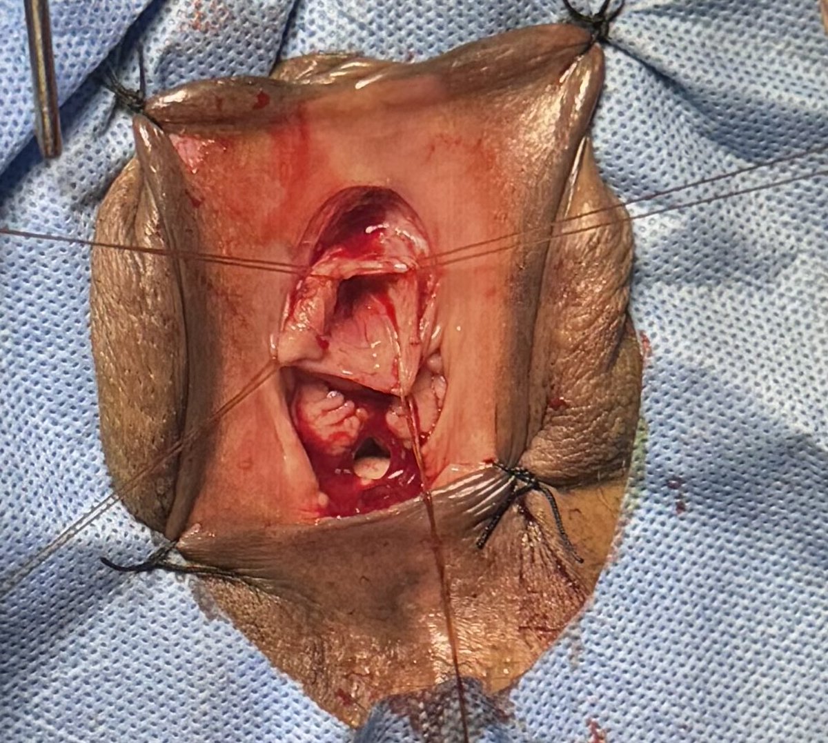 PrajwalPaudyal's tweet photo. BMG anterior onlay urethroplasty for female urethral stricture https://t.co/91iigT0Gwf