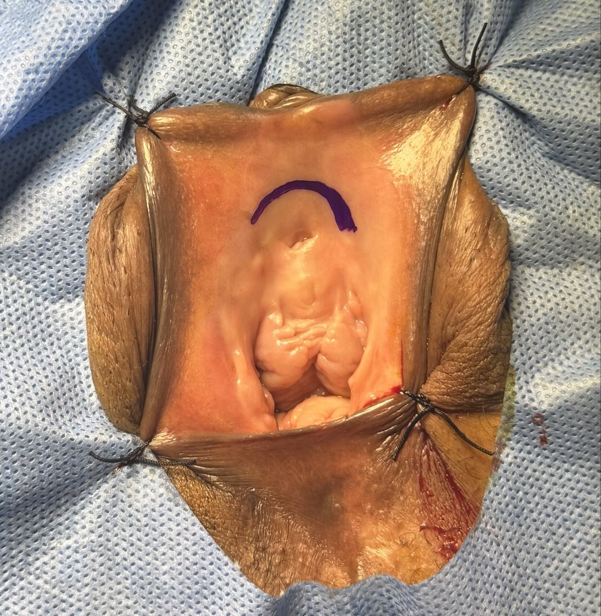 PrajwalPaudyal's tweet photo. BMG anterior onlay urethroplasty for female urethral stricture https://t.co/91iigT0Gwf