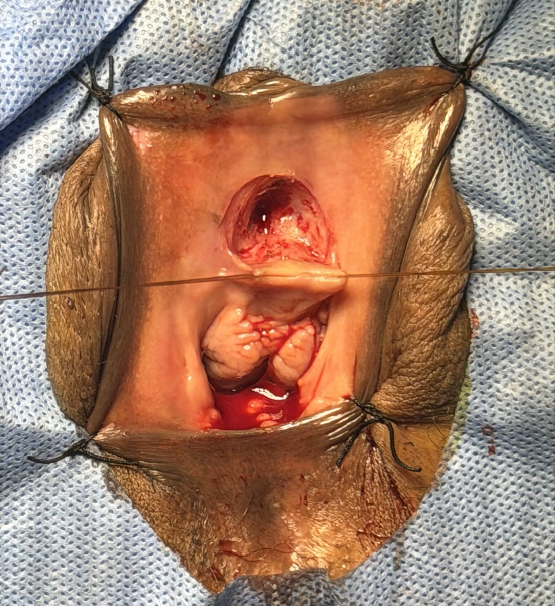 PrajwalPaudyal's tweet photo. BMG anterior onlay urethroplasty for female urethral stricture https://t.co/91iigT0Gwf
