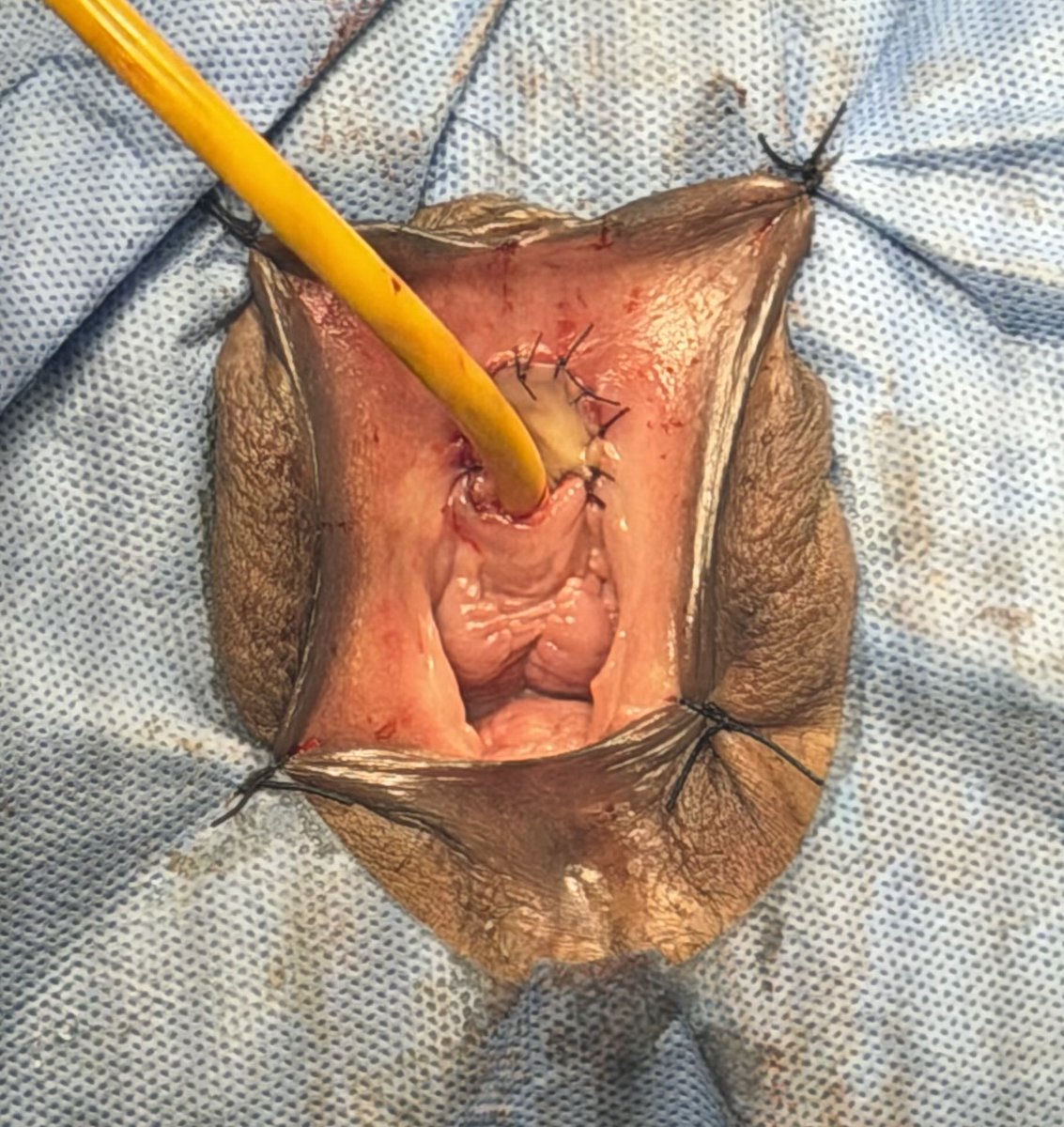 PrajwalPaudyal's tweet photo. Female BMG urethroplasty contd… https://t.co/2QCbAgT52Y
