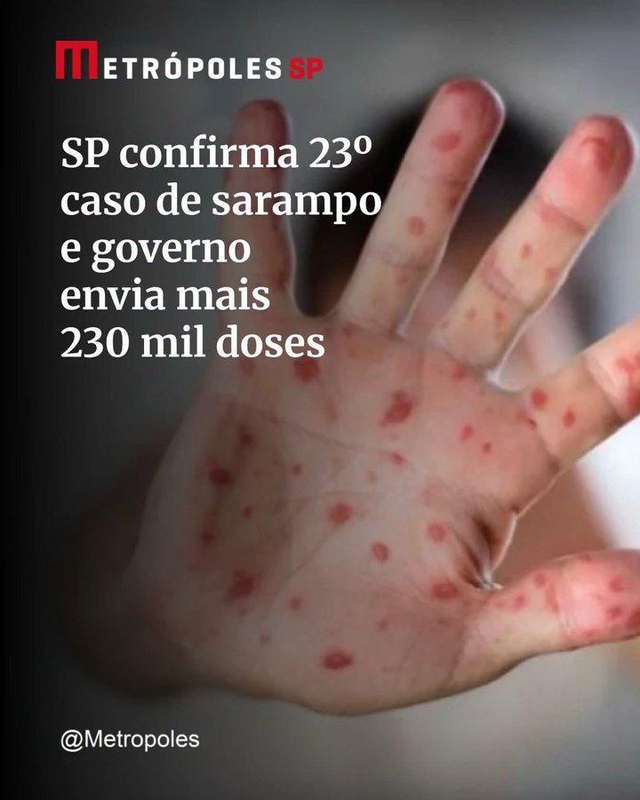 toninhodocall's tweet photo. Essa é uma das grandes obras nefastas do bolsonarismo:

 crianças morrendo de sarampo. https://t.co/WvsyUmORlO