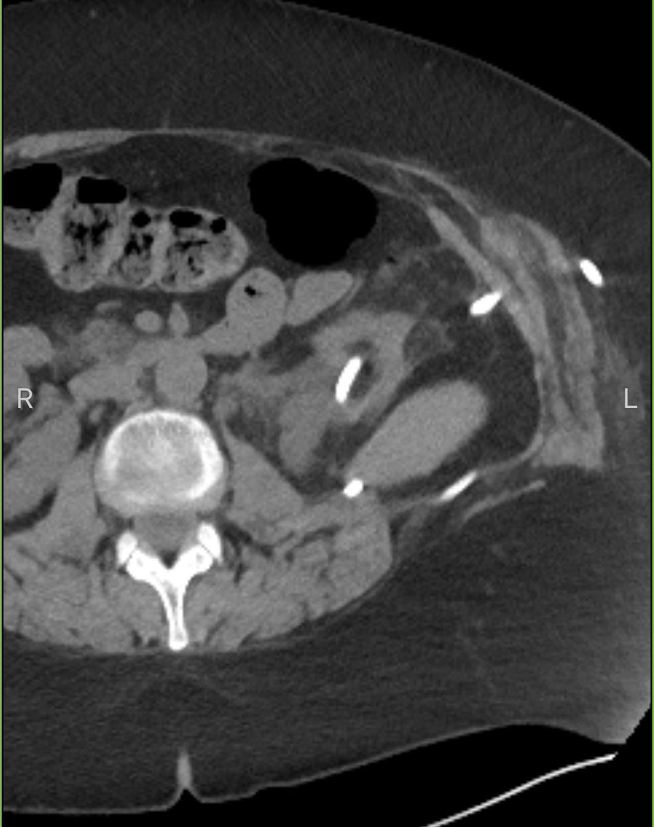 ryansteinbergmd's tweet photo. Proud of this one. Hx of cystectomy+IC, open PNx. Now large stone burden. CT w retro renal spleen &amp; existing PCN (27 cm SSD) in only reasonable access spot. Lower pole access achieved, pt stone free with PCNL. Complex cases alive and well at @UIowa_urology https://t.co/g9hiuO36pN