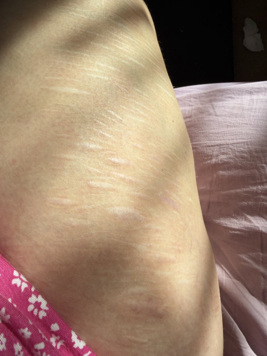 BubbleBlush0's tweet photo. 1 year old scars i think aside from arm, arms about likeee 3 years maybe https://t.co/H7FHCCOWpR