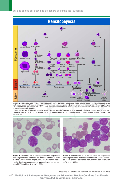 RhenalsMedint's tweet photo. Hoy me preguntaron "cuantos neutrofilos eran desviacion a la izquierda en un hemograma?" y me acordé de esta foto que siempre he subido aqui.

La DESVIACION A LA IZQUIERDA NO ES NEUTROFILIA, es la aparición en sangre periferica de formas INMADURAS de los granulocitos. https://t.co/XH25m0pqPL