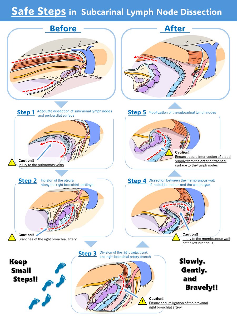 jses_eng's tweet photo. 🎨 2nd JSES Illust Contest #5
📌 Safe Steps in  Subcarinal Lymph Node Dissection
🖊 Yuji Hatanaka
#JSESイラストコンテスト #JSES_illustration_contest https://t.co/H58p7DKKDG