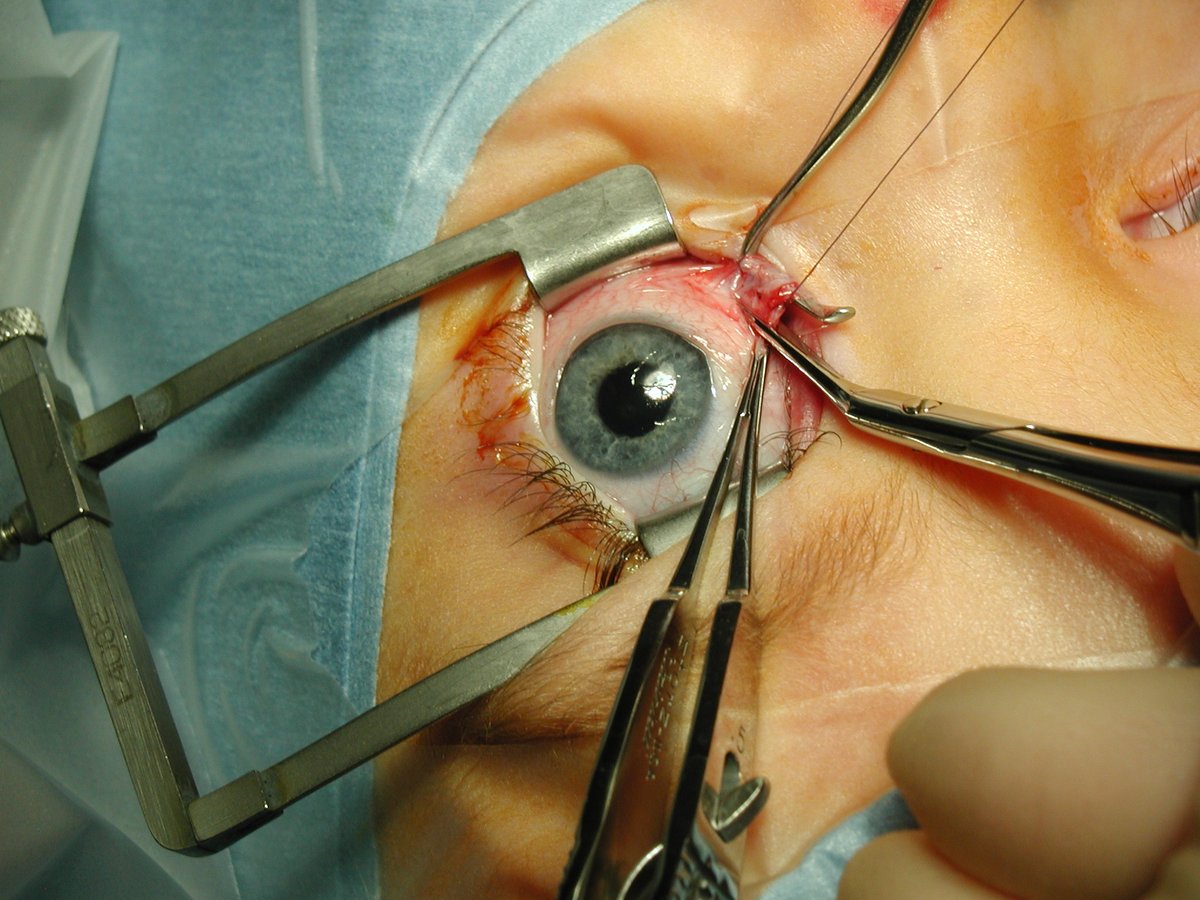 revoptom's tweet photo. Children with Neurodevelopmental, Behavioral Disorders Face Greater Risk of Eye Disease
These individuals were less likely to undergo corrective surgery for ocular misalignment.
https://t.co/29k2WyO2Ze
#optometry #optometrist #eyecare #adhd #myopia #amblyopia #strabismus https://t.co/e8ueoGeuKU