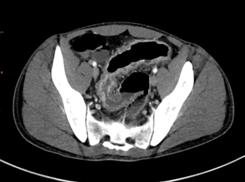 dAIgnositX's tweet photo. Abdominal pain. Nausea. Vomiting. Diarrhea.

A routine GI illness... or something more?

The CT is in. What's your diagnosis?

👉 Cast your vote: https://t.co/w42GIW1SGn

#MRI #MSK #Radiology #CaseOfTheWeek https://t.co/BQ8JH0pAkq