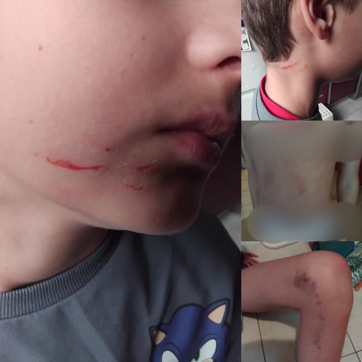 kaotik747's tweet photo. Aaron, 12 ans, en situation de handicap. Victime d’agressions au sein de son IME ! Une plainte déposée mais tjs ce lourd silence…
Comment ne pas avoir les larmes aux yeux…
Demain matin, vous découvrirez son histoire et le témoignage bouleversant de sa maman.
À toutes les institutions : je ne me tairai pas. Nos enfants doivent être protégés.
Kao✊🏻✊🏽✊🏿✨❤️🇫🇷