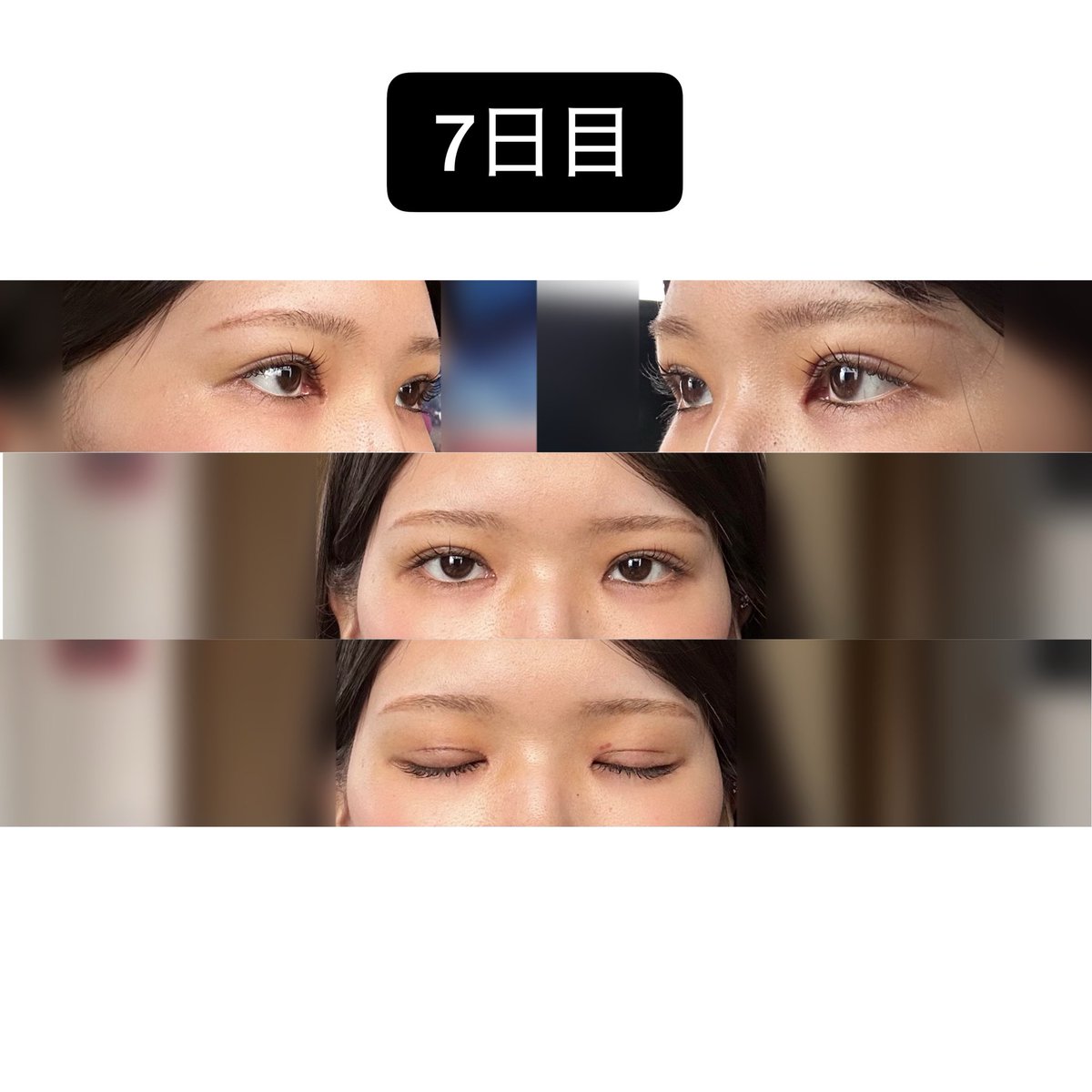 cocoasuzu619's tweet photo. イエロー整形外科＠yellowps_jp

目の再手術(部分切開+目頭･目上切開+目つき矯正)　1週間経過

術直後からすごく綺麗で、まだ内出血残ってるけどこれから腫れが引いていくのが楽しみです! https://t.co/uZ989mPGK5