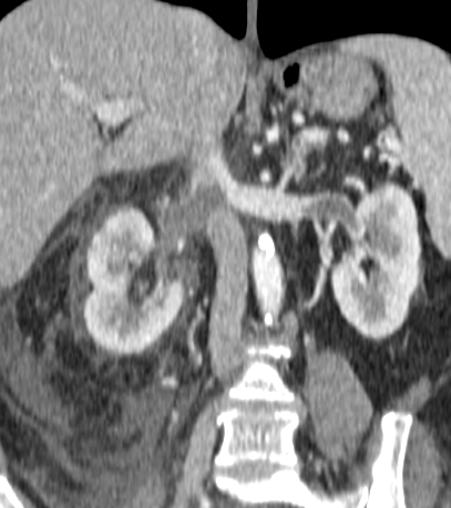 ItaniMalak's tweet photo. Case #27 in 2026
56 yo woman with flank pain
What's your diagnosis?
Answer in the comment
#MedEd #rad #radiology #abdrad #abdomen #imaging #nephrology https://t.co/cjZKxk7wBD