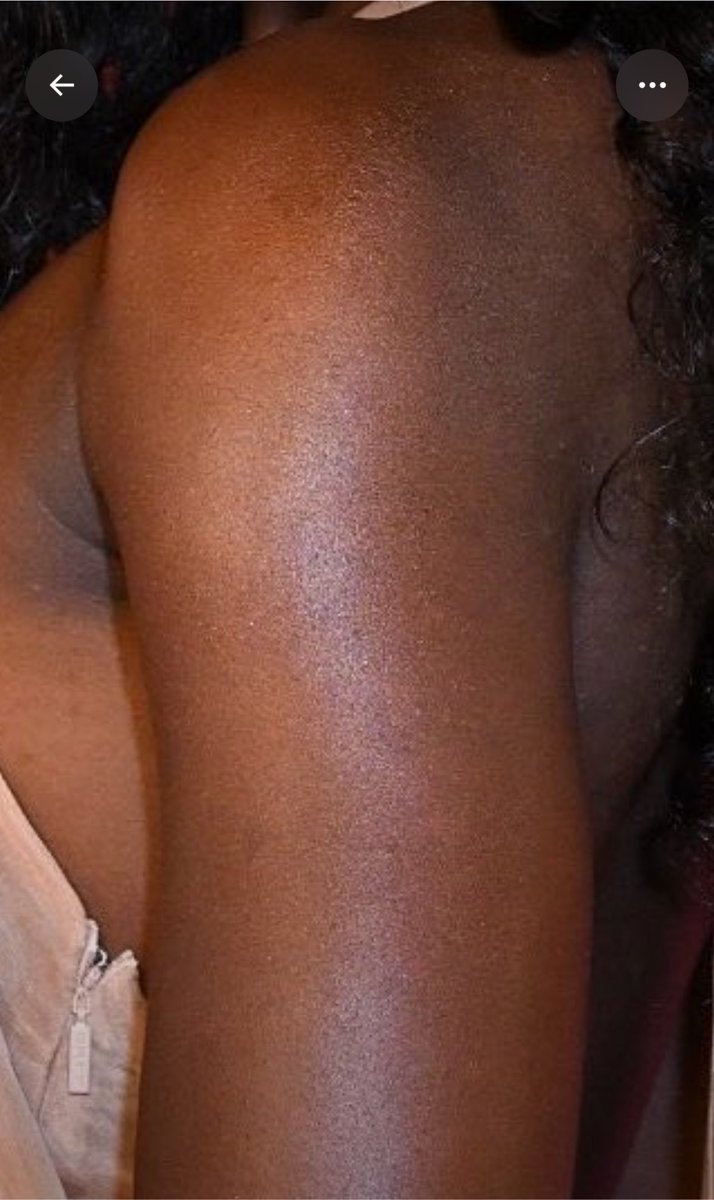 AlluredbyNature's tweet photo. Aniya angels please don’t forget to add cocoa butter, moisturizer and glycolic acid when gifting Aniya 😭I can’t stand this eczema skin and that burnt armpit😭😭😭 https://t.co/zB6WBTlEfg