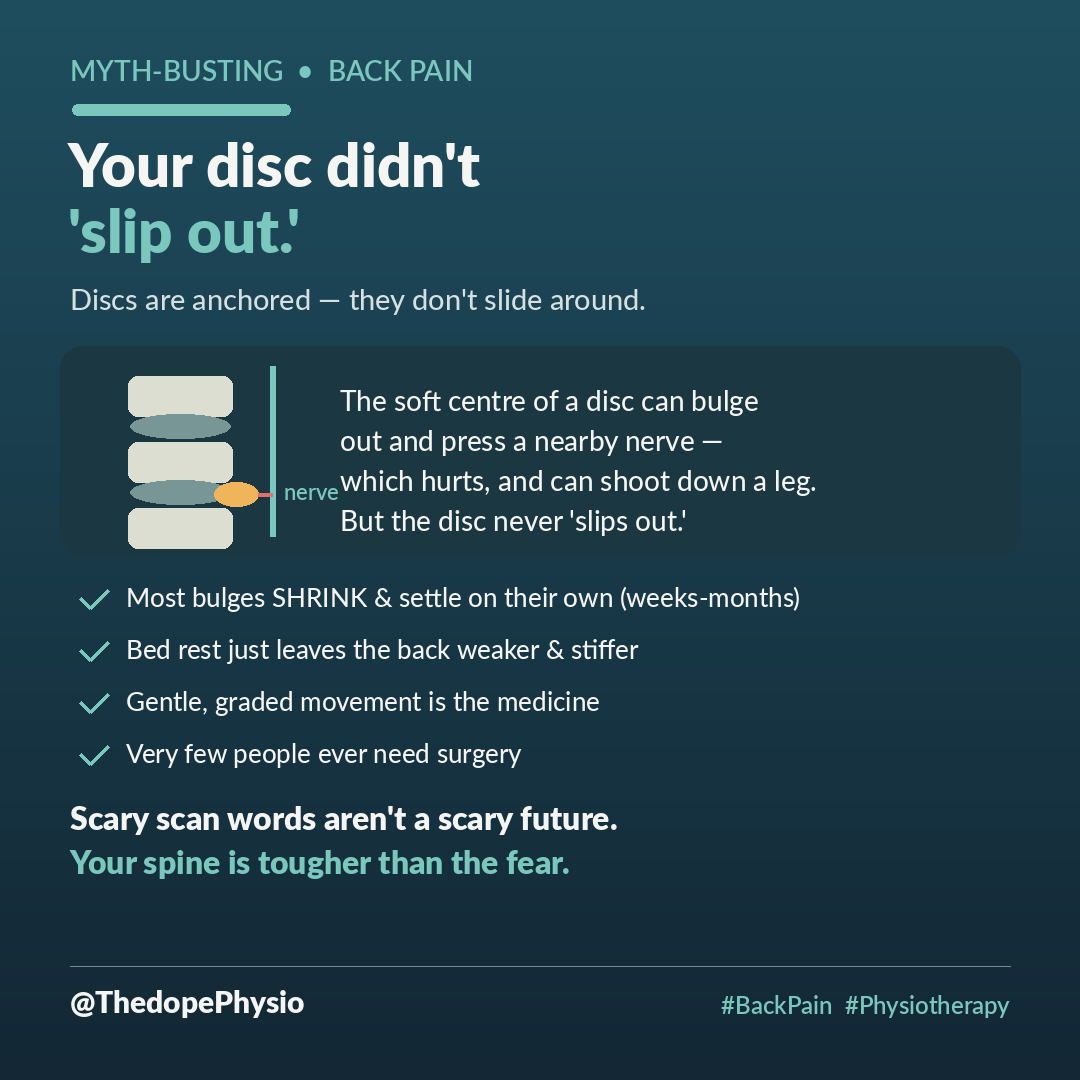 ThedopePhysio's tweet photo. The words alone are terrifying: "your disc has slipped." You picture something popping out of place in your spine, one wrong move from a wheelchair. So you stop bending, stop lifting, stop moving, and quietly plan a smaller life. Take a breath. It's not what you think.

First, the name lies. A disc cannot "slip out." Your spinal discs are firmly anchored between the bones — they don't slide around like a loose coin. What actually happens is that the soft centre of a disc bulges outward and can press on or irritate a nearby nerve. That can genuinely hurt, and even shoot down a leg, but "slipped," it is not.

Now the part the scary scan words leave out: most disc bulges shrink and settle on their own. Your body actually reabsorbs much of that bulging tissue over weeks to months. Symptoms usually calm with time and the right movement, not with bed rest, which just leaves a back weaker and stiffer.

Gentle, graded movement and strengthening is the medicine for most disc pain. Very few people ever need surgery.

A "slipped disc" is not a life sentence, and a scary scan word is not a scary future. Move carefully, consistently. Your spine is far tougher than the fear lets you believe. 🦴

#BackPain #Physiotherapy #NigeriaNews