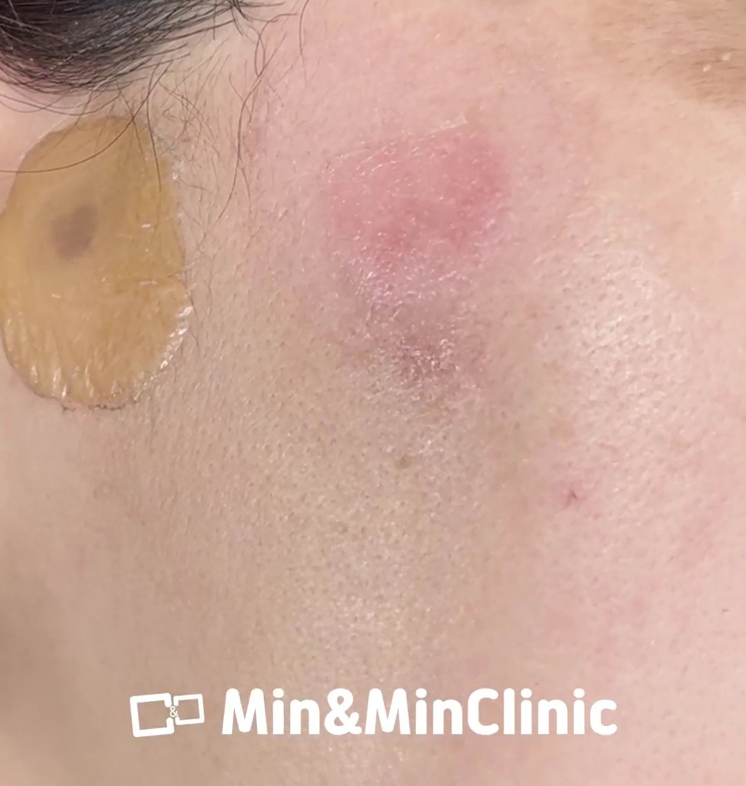doublemclinic's tweet photo. 写真で注目してほしいのは、
シミの「色」だけではありません。

今回のケースでは、施術後に色素部分が浮き上がり、
その後ポロッと落ちていく経過が見られました。

今回ダブルMで選んだ施術が気になる方は
「色素」とコメントしてください。

#ダブルM 
#韓国美容 
#シミケア 
#くすみケア https://t.co/ESgBpyCH3O