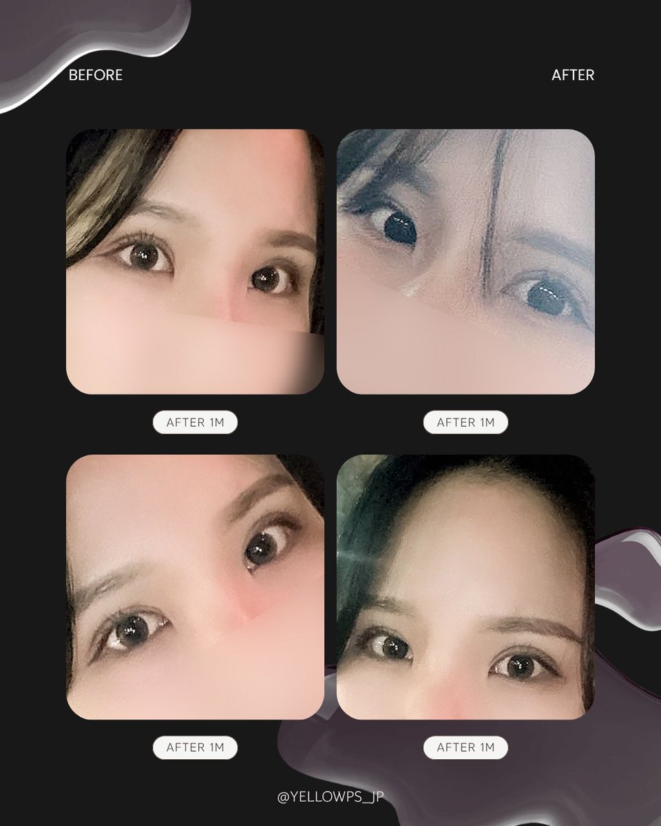yellowpsjp's tweet photo. イエロー症例💛

二重手術なしで、
トゥイム(트임)だけでどのくらい変わりますか？

・手術内容
目頭目上切開
目尻切開＋タレ目形成(グラマラスライン)

✔日本語担当者常住
✔腫れケア無制限

【韓国】イエロー美容整形外科
📍ソウル市江南区江南大路406, 5F
📲お問い合わせ：https://t.co/3qL2oSqVPR https://t.co/uGcGz26MFu