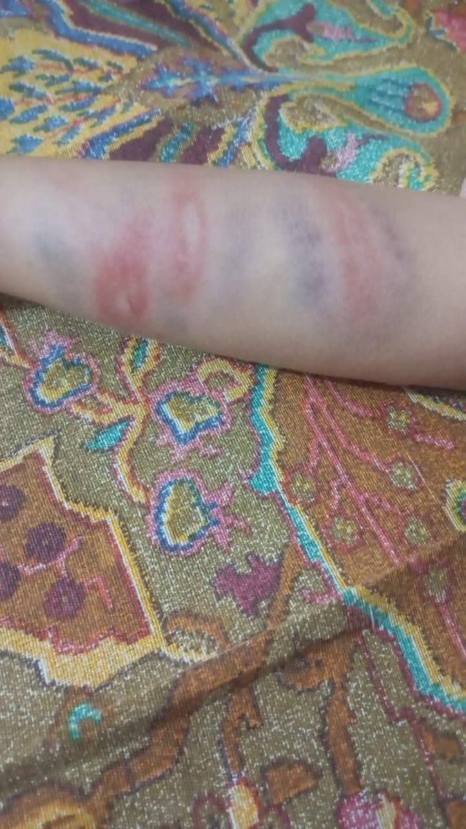 Bhatties68's tweet photo. بر سوات سمبٹ میں ظلم کی انتہاء، دی ایگل فورٹ سکول میں  فضل رحیم نامی استاد نے (جو کہ اس سکول کا مالک بھی ہے) نے پانچویں جماعت کے طالب علم سلمان پر اس قدر تشدد کیا ہے کہ اسکے پورے جسم میں کوئی بھی جگہ سلامت نہیں ہے۔ معصوم بچہ چیختا چلاتا رہا لیکن استاد اسے مارتا رہا۔ ذرائع کے مطابق مار پٹائی میں فضل رحیم کیساتھ ایک اور استاد بھی شریک تھا ۔
