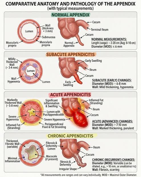 AymanAlatas's tweet photo. Pov as SpMK terkait kasus “Usus Buntu” -> penasaran indikasi antibiotik di kasus yang lagi viral karena diinfoin hanya “banyak feses” tapi kenapa pengobatannya pake AB.
Lalu pertimbangan pula pengaruh terapi di Indonesia sebelum cek ke RS di luar negeri karena ada kemungkinan sudah resolusi paska-terapi dan ada risiko rekurensi.