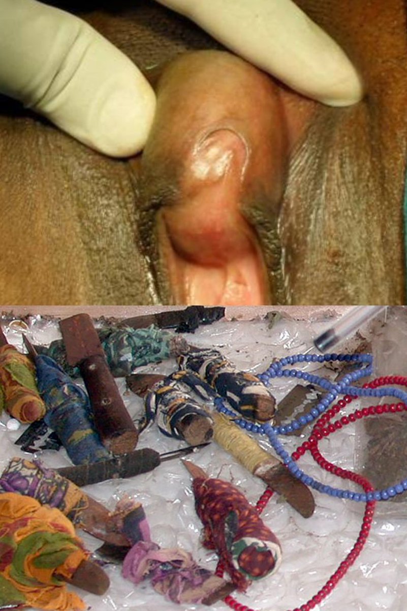 thegirdlengr's tweet photo. My #FGM Torture💔
"I Went Through 4 Surgeries To Get Rid Of The Cysts FGM Caused On My Clitoral Hood!"

Evangeline Mukami Recounts:
"I was very young; probably 10 years old. It was early in the morning. I was told to sit on banana leaves. I was held down by women; some of them my https://t.co/DMsdRValNK