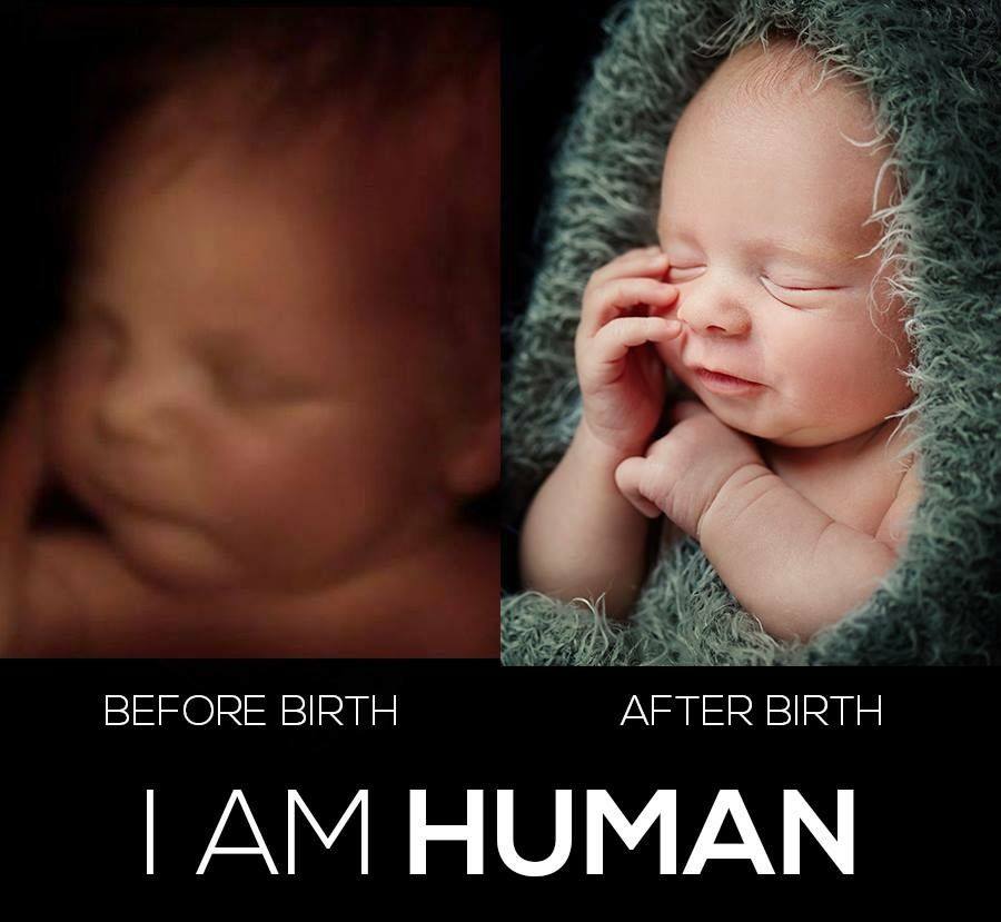 CoffeeTyme2's tweet photo. Hey Healey>
Now we can do surgeries on pre-born babies..in-utero surgeries ..laser vascular, spina bifida corrective surgeries and more.
If a pre-born baby is treated as a PATIENT, than that patient is a PERSON. ALL patients deserve rights. ABORTION is NOT healthcare.
VOTE HEALEY OUT!  2026