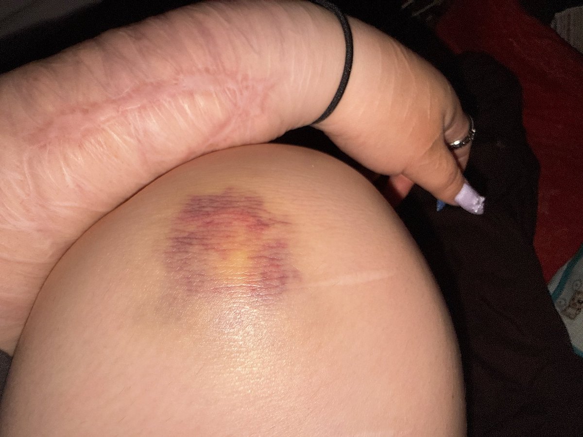 OD_report_'s tweet photo. 短足豚足汚ねぇ腕失礼
この前殴って出来た痣可愛い https://t.co/BkJV4m3BJT