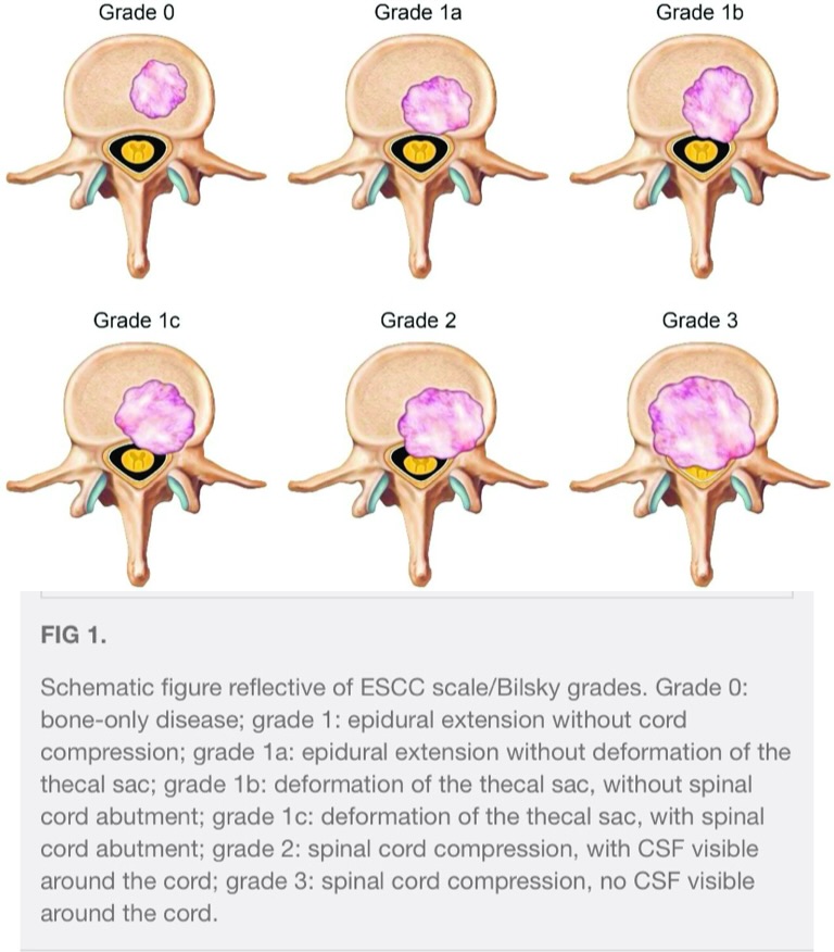 TheAJNR's tweet photo. Check #AJNR Editors’ choice of the month: ‘’Spinal Metastasis Reporting: Evidence-Based Recommendation on Behalf of the American Society of Spine Radiology Education and Standards Committee’’
As spinal metastases become increasingly common due to advances in cancer treatment, imaging plays a central role in diagnosis and treatment planning, making consistent reporting essential. This ASNR/ASSR white paper presents an evidence-based framework for structured MRI reporting of spinal metastases, emphasizing essential reporting elements while introducing advanced imaging concepts and laying the foundation for future updates.

https://t.co/C9kCJu67Vr

#neuroscience #neuroradiology #radres #medstudent