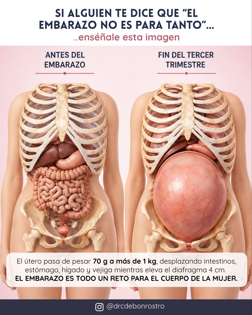 drcdebonrostro's tweet photo. ⚠️ ¿SEGURO QUE EL EMBARAZO “NO ES PARA TANTO”?

En 40 semanas, el útero se multiplica de tamaño y los órganos abdominales cambian radicalmente de posición.

Cuando alguien diga que “no es para tanto”… QUIZÁ BASTE CON ENSEÑARLE ESTA IMAGEN 👇🏼👇🏼👇🏼

#Embarazo #Obstetricia https://t.co/yckN9zEkU0
