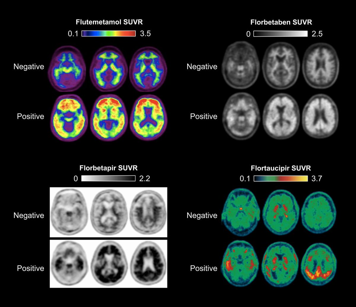 JournalofNucMed's tweet photo. Updated appropriate use criteria for amyloid and tau PET: A report from the Alzheimer’s Association and Society for Nuclear Medicine and Molecular Imaging workgroup: https://t.co/4I28beVJrK
#NuclearMedicine #PETscan @alzassociation @SNM_MI https://t.co/NiBMi0BjmY