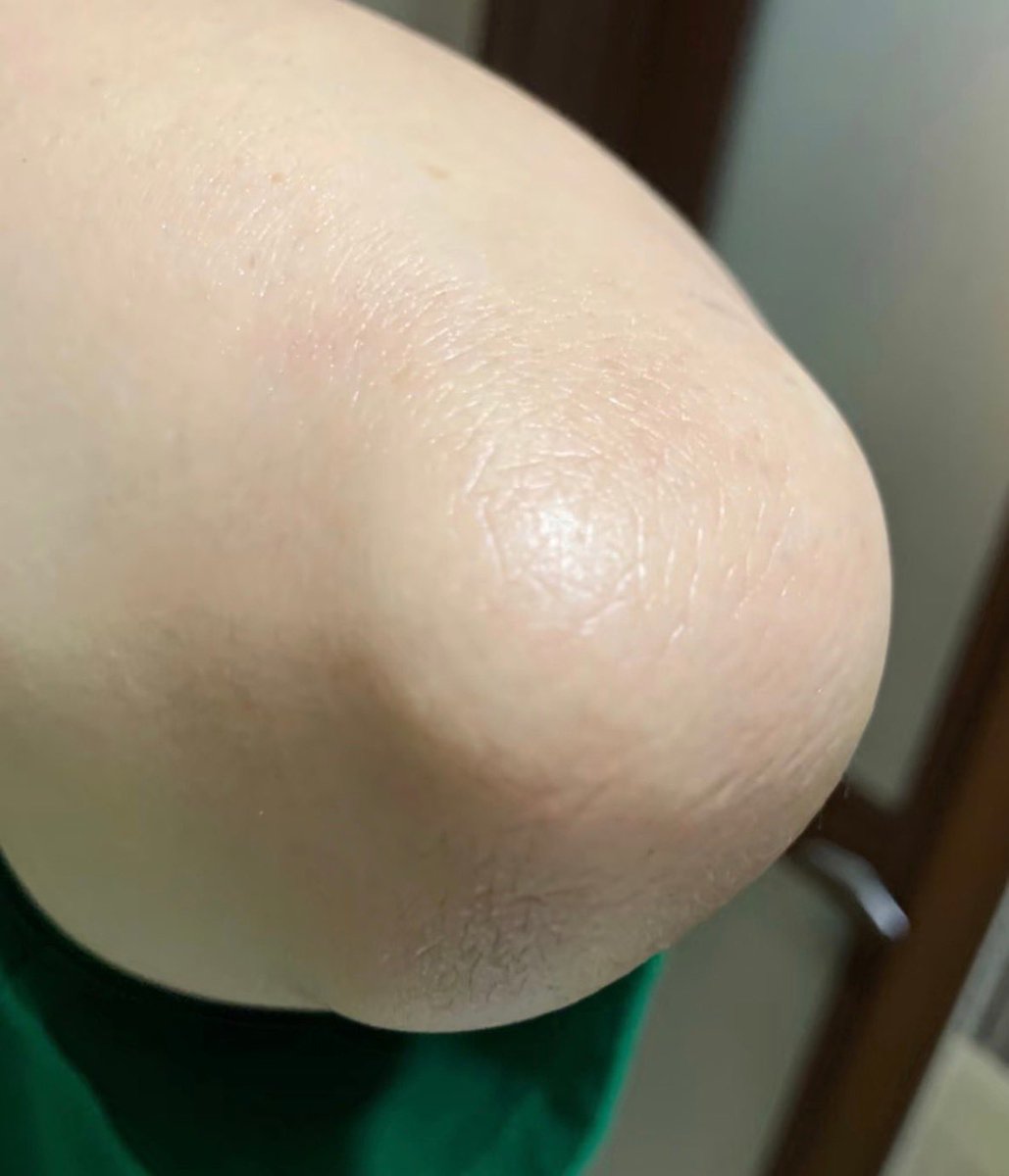 kitty_yamiyami's tweet photo. 10代の頃から肘の黒ずみずーーーっと悩んでたけど、毎日これ塗りたくってたら1ヶ月で消え去った。Twitterありがとう🥲 https://t.co/pmanvFXgij