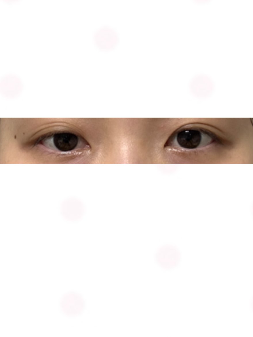 zdtixt58461's tweet photo. #目整形レポ  

手術1カ月
←Before　After→

二重の左右差がなくなって、スッキリして気に入ってる。
印象が明るいというか頭良さそうに見える、、

腫れとあざが本当に少ないのが良かった、、
手術して良かったと思う(´っ;ω;c `)

#韓国整形 #整形垢さんと繋がりたい 
#ルビー美容外科
@rubyps_jp https://t.co/iSJHZaDlUK