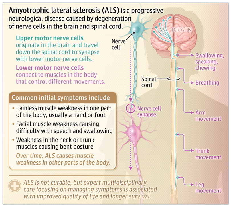 JAMA_current's tweet photo. Approximately 25 000 people in the US live with #ALS, a condition with typical onset after age 40 and rapid progression. Most patients experience muscle weakness, fatigue, and difficulties with speech, swallowing, or breathing. 

📄 This JAMA Patient Page describes how common amyotrophic lateral sclerosis (ALS) is and who is typically affected along with information about the diagnosis, treatment, and prognosis of ALS. 

https://t.co/wEoSEY9znx