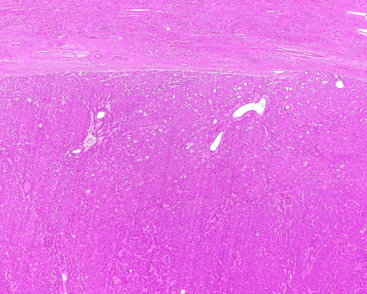 LizMontgomeryMD's tweet photo. Cholangioblastic cholangiocarcinomas are really interesting - I am old so I like the old name!
Hissong E, et al. NIPBL::NACC1 Fusion Hepatic Carcinoma. Am J Surg Pathol. 2024 Feb 1;48(2):183-193. PMID: 38047392; PMCID: PMC11238093. https://t.co/BrWH7GDnRT