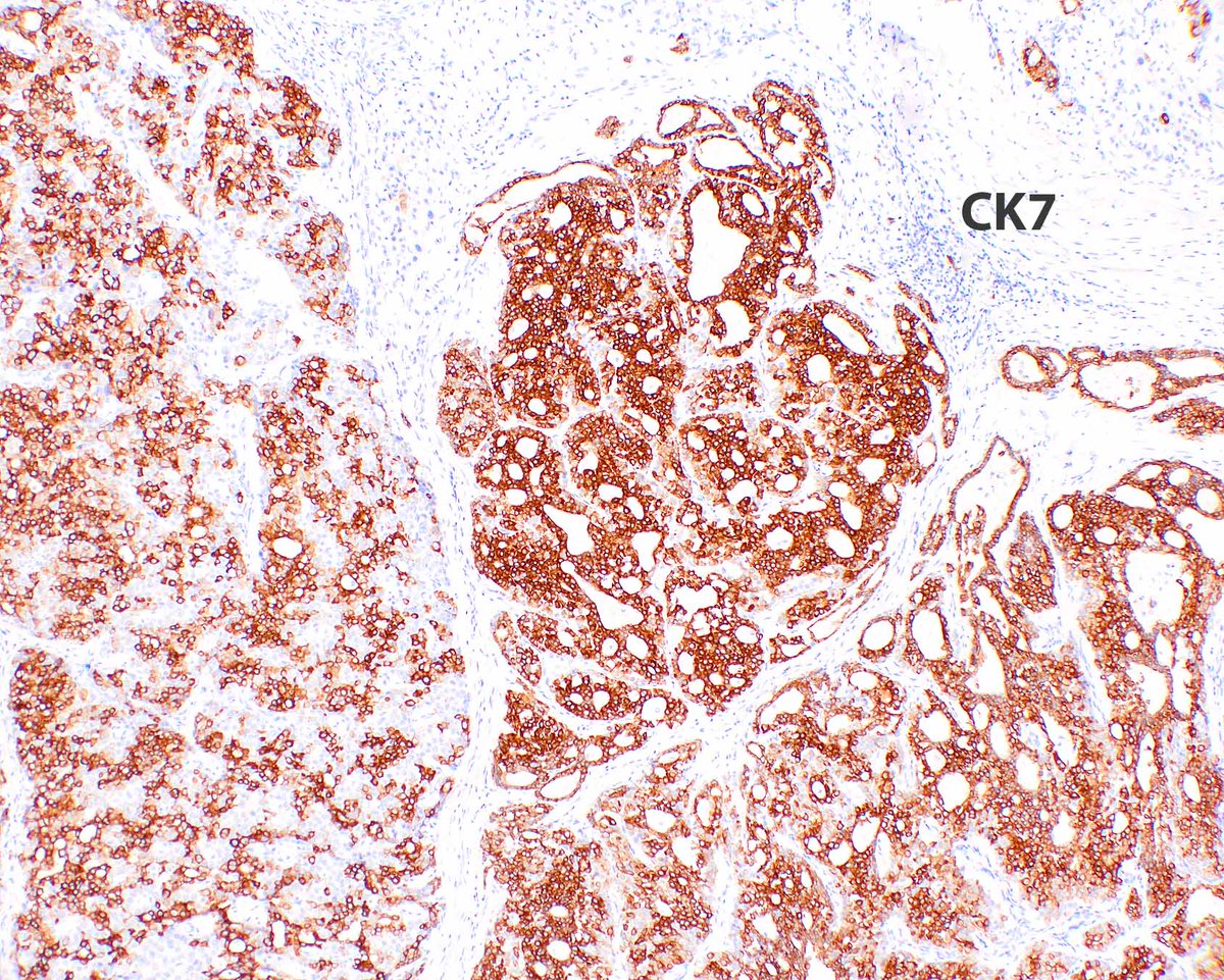 LizMontgomeryMD's tweet photo. Cholangioblastic cholangiocarcinomas are really interesting - I am old so I like the old name!
Hissong E, et al. NIPBL::NACC1 Fusion Hepatic Carcinoma. Am J Surg Pathol. 2024 Feb 1;48(2):183-193. PMID: 38047392; PMCID: PMC11238093. https://t.co/BrWH7GDnRT