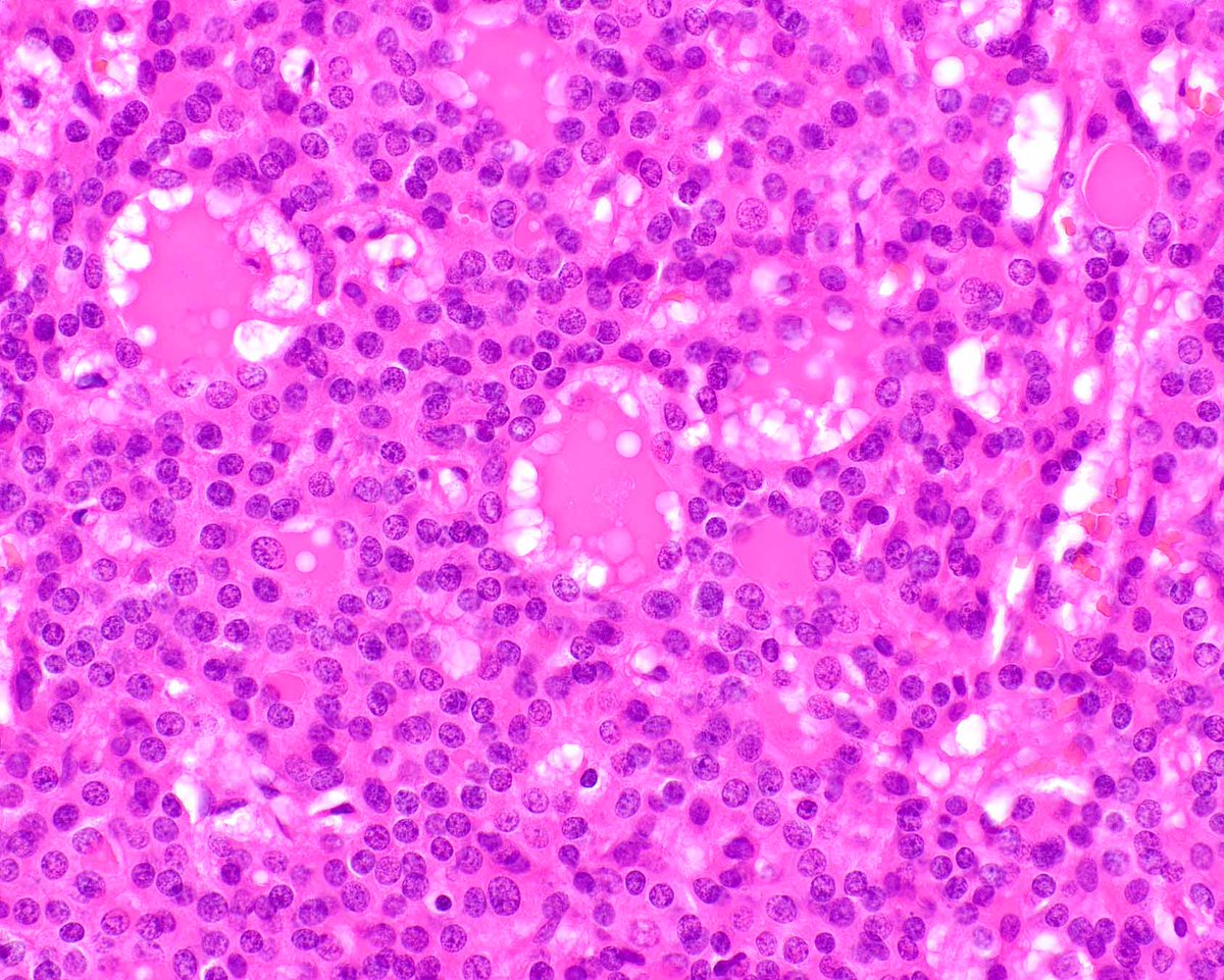 LizMontgomeryMD's tweet photo. Cholangioblastic cholangiocarcinomas are really interesting - I am old so I like the old name!
Hissong E, et al. NIPBL::NACC1 Fusion Hepatic Carcinoma. Am J Surg Pathol. 2024 Feb 1;48(2):183-193. PMID: 38047392; PMCID: PMC11238093. https://t.co/BrWH7GDnRT