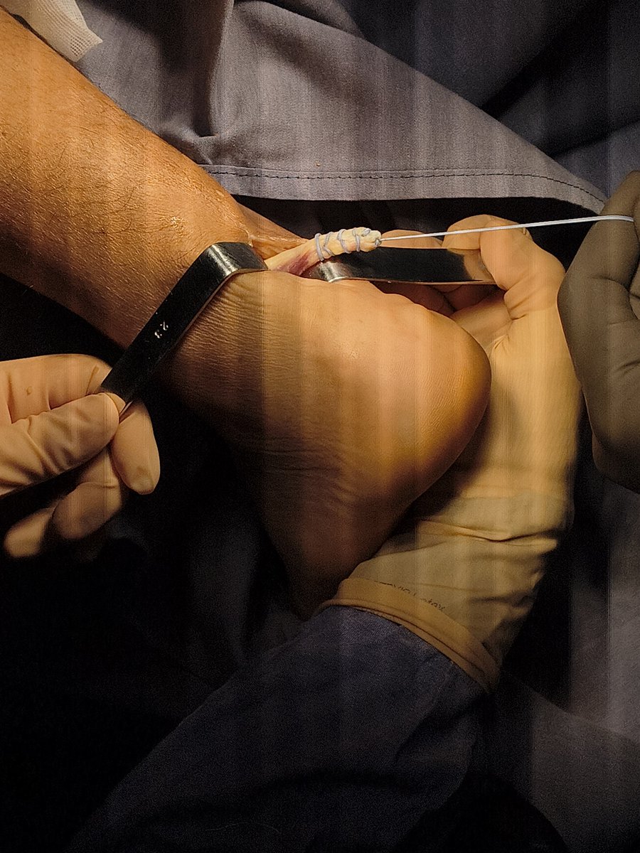 Torlsteinacst's tweet photo. Ruptura del tendón de Aquiles crónica, se realiza transposición del FHL + colocación de ancla en calcáneo como tratamiento alternativo al encontrarse retraido más de 5 cm
#med #medicine #tyo #orthopedicsurgery #radiology #traumatology #pieytobillo #footandankle #aquiles https://t.co/2RTYPgTSv2