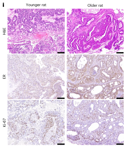 MammaryCell's tweet photo. Estrogen receptor-positive #BreastCancer is the most common subtype of breast cancer and is an age-related disease.

Researchers at the Lee lab at @UPMCHillmanCC identified age-associated differences in tumor development and immune features: https://t.co/hdCuV27GpE https://t.co/xRmhlBFoNk