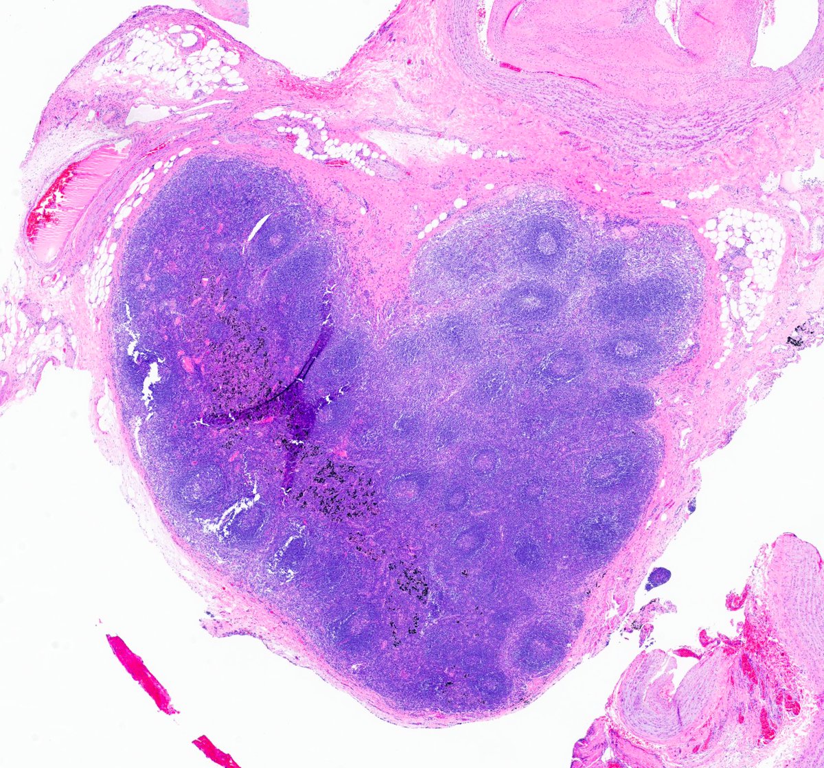 Saroja_DeviG's tweet photo. Monday Blues Antidote πΈ
Was going through a π« lobectomy with lymph node dissection. There were SO many LNs, & just as the task was getting long & cumbersome, this little heart-shaped LN popped up to show me some love β€οΈπ¬
#PathTwitter #PulmPath #Pathology #MedTwitter https://t.co/dcCGYRXXDP