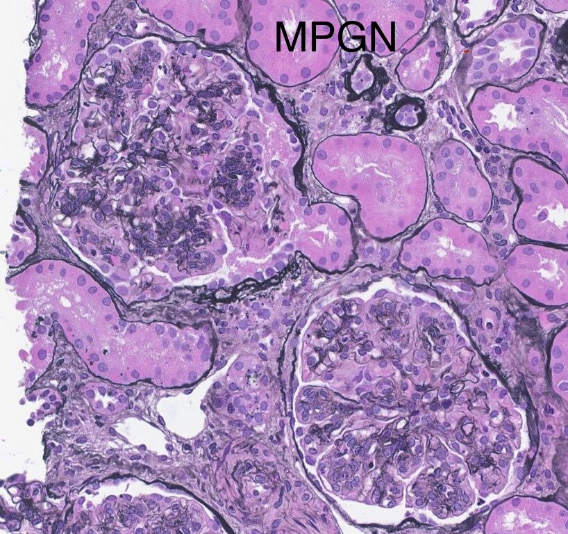 SethiRenalPath's tweet photo. Mimic:
IgA Nephropathy can mimic immune complex (IC)-MPGN.

LM: Membranoproliferative (MPGN) pattern
Routine IF: inconclusive
Pronase IF: mesangial IgA 2+
EM: mesangial deposits

Dx: IgA nephropathy M1 E1 S0 T0 C0

Case was labeled primary IC-MPGN

50-yr old with hematuria and proteinuria. Serology negative.