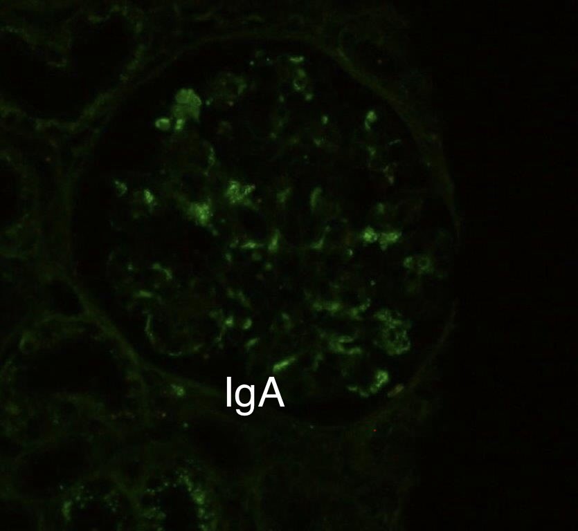 SethiRenalPath's tweet photo. Mimic:
IgA Nephropathy can mimic immune complex (IC)-MPGN.

LM: Membranoproliferative (MPGN) pattern
Routine IF: inconclusive
Pronase IF: mesangial IgA 2+
EM: mesangial deposits

Dx: IgA nephropathy M1 E1 S0 T0 C0

Case was labeled primary IC-MPGN

50-yr old with hematuria and proteinuria. Serology negative.