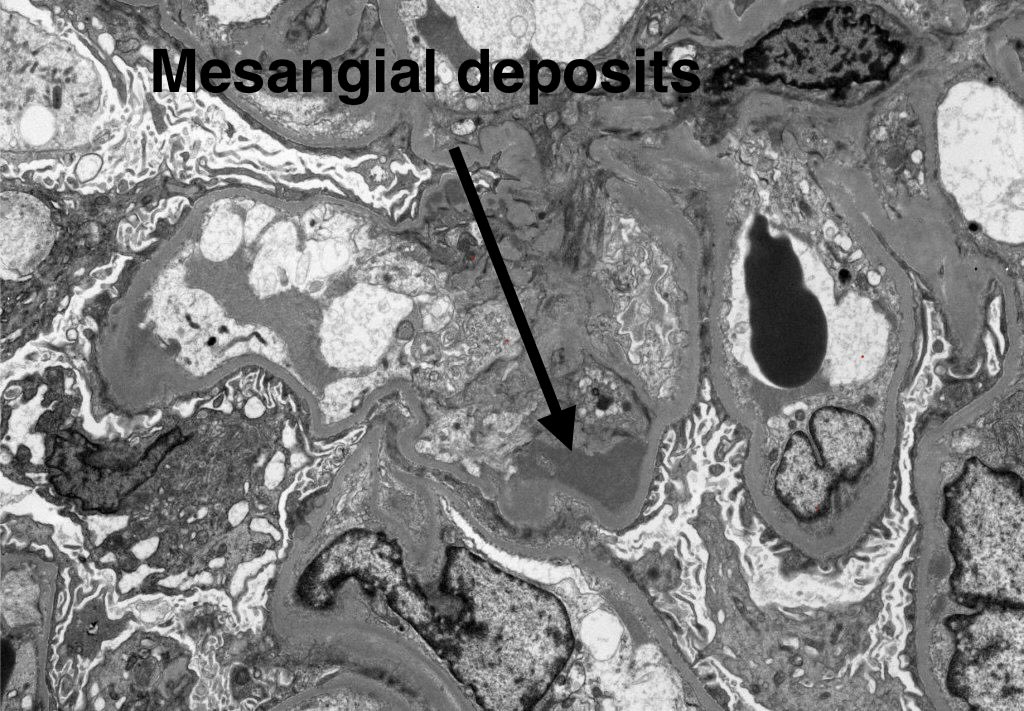 SethiRenalPath's tweet photo. Mimic:
IgA Nephropathy can mimic immune complex (IC)-MPGN.

LM: Membranoproliferative (MPGN) pattern
Routine IF: inconclusive
Pronase IF: mesangial IgA 2+
EM: mesangial deposits

Dx: IgA nephropathy M1 E1 S0 T0 C0

Case was labeled primary IC-MPGN

50-yr old with hematuria and proteinuria. Serology negative.