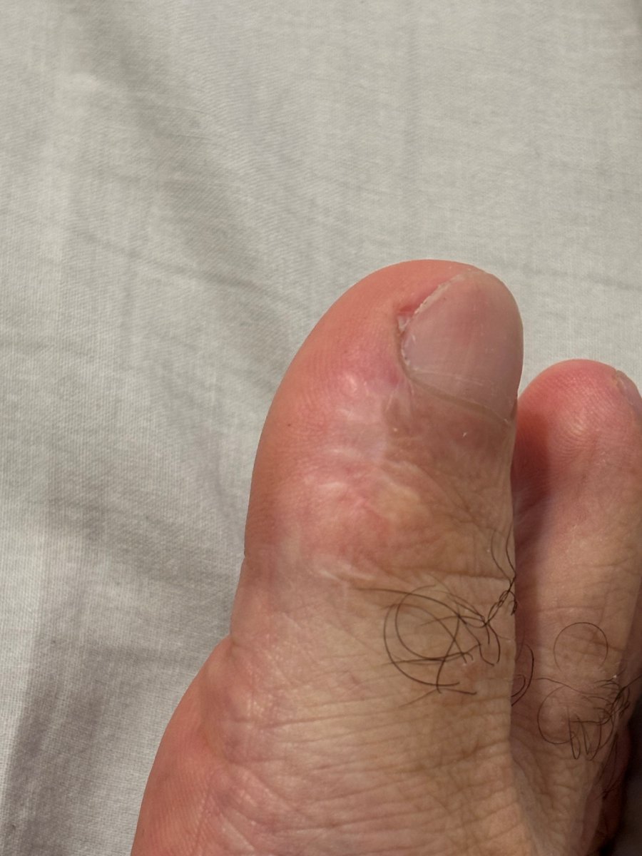 1979cwm's tweet photo. Close-up of the scar on my right big toe

#feet #toes #soles #barefoot https://t.co/iowkGjYBL4