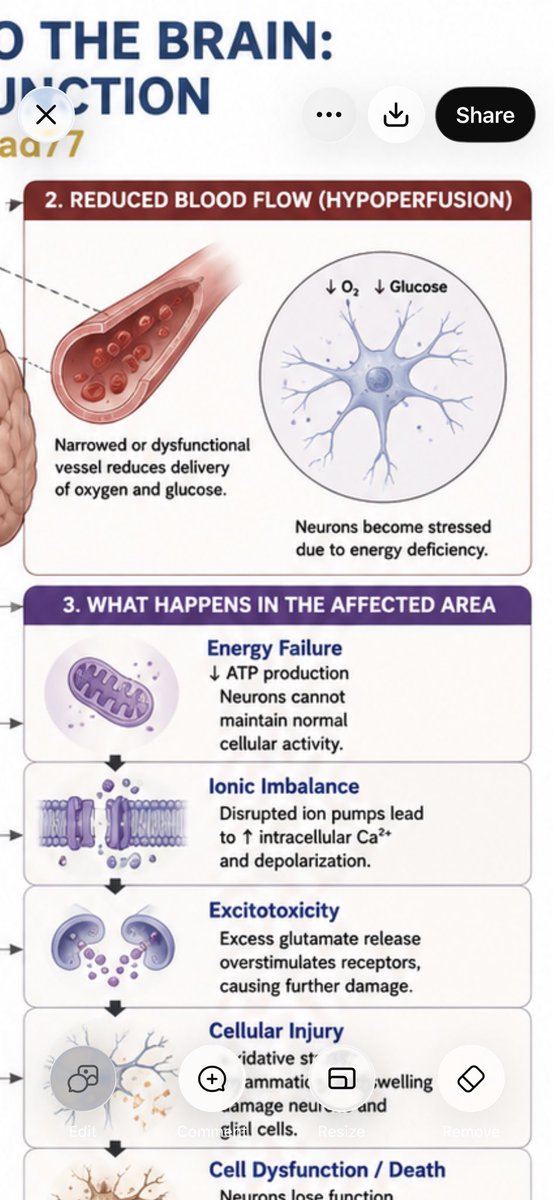 AutonomicBrad77's tweet photo. Reduced blood flow makes neurons “stressed” due to energy deficiency. #LongCovid #pwME #POTS #Dysautonomia #hEDS #EhlersDanlos #pwLC https://t.co/OQbERMcYan
