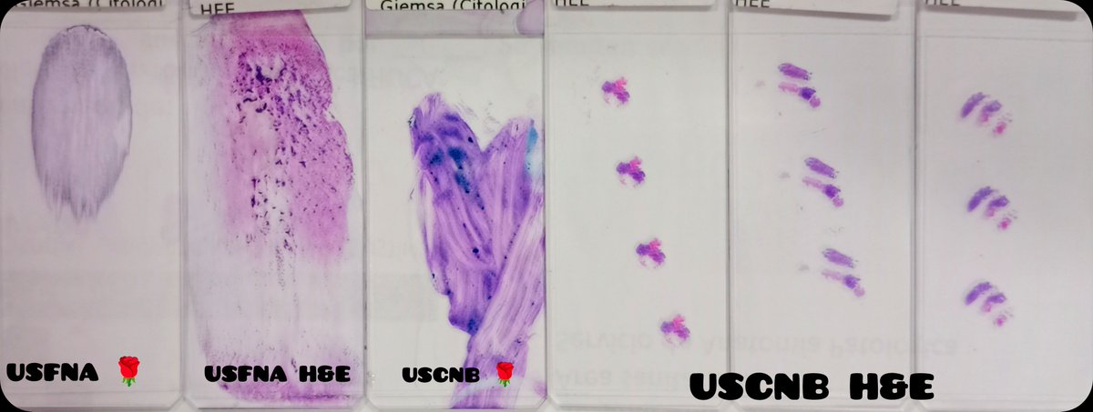 duckhuca's tweet photo. Last case before holidays.
🦀 Medical record: anal neoplasm.
🦵🏽 Subcutaneous lesion on the leg.
🖥️ Hypoechoic, irregular edges. 📏 36mm.
💉 Ultrasound guided FNA / CNB performed by Interventional Pathologist (Dr @LangerPath)
2️⃣5️⃣ and 1️⃣4️⃣ g.
🔬 Metastatic Squamous Cell Carcinoma. https://t.co/MuwhTw7Qku