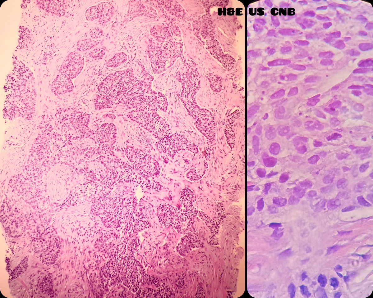 duckhuca's tweet photo. Last case before holidays.
🦀 Medical record: anal neoplasm.
🦵🏽 Subcutaneous lesion on the leg.
🖥️ Hypoechoic, irregular edges. 📏 36mm.
💉 Ultrasound guided FNA / CNB performed by Interventional Pathologist (Dr @LangerPath)
2️⃣5️⃣ and 1️⃣4️⃣ g.
🔬 Metastatic Squamous Cell Carcinoma. https://t.co/MuwhTw7Qku